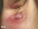 hidradenitis