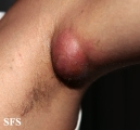 hidradenitis
