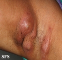 hidradenitis