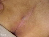 pilonidal sinus
