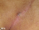 pilonidal sinus