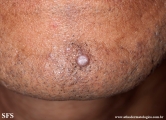 trichofoliculoma