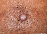 trichofoliculoma