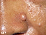 trichofoliculoma