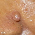 trichofoliculoma