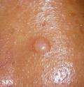 trichofoliculoma
