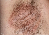 erytrasma and trichomycosis axillaris