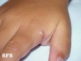 actinic prurigo