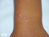 actinic prurigo