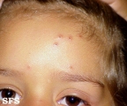 actinic prurigo