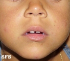 actinic prurigo