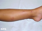 actinic prurigo