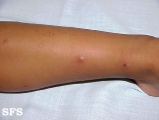 actinic prurigo