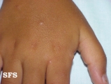 actinic prurigo