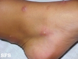 actinic prurigo