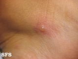 actinic prurigo