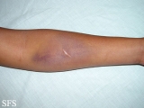 painful bruising syndrome