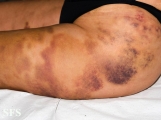 painful bruising syndrome
