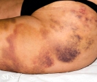 painful bruising syndrome