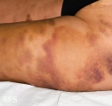 painful bruising syndrome