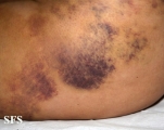 painful bruising syndrome