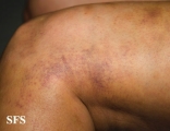 painful bruising syndrome