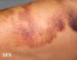 painful bruising syndrome