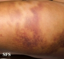 painful bruising syndrome