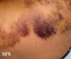painful bruising syndrome