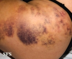 painful bruising syndrome