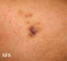 painful bruising syndrome