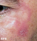 polymorphic light eruption