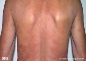 leprosy lepromatous