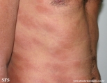leprosy lepromatous