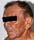 leprosy lepromatous