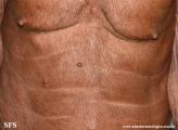 leprosy lepromatous