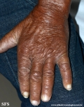 leprosy lepromatous