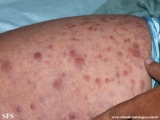 leprosy lepromatous
