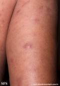 leprosy lepromatous
