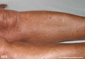 leprosy lepromatous