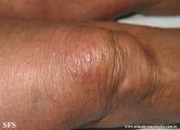 leprosy lepromatous