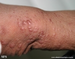 leprosy lepromatous