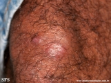 leprosy lepromatous