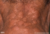 leprosy lepromatous