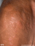 leprosy lepromatous