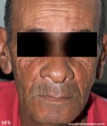 leprosy lepromatous
