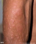 leprosy lepromatous