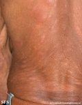 leprosy lepromatous