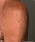leprosy lepromatous