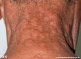 leprosy lepromatous